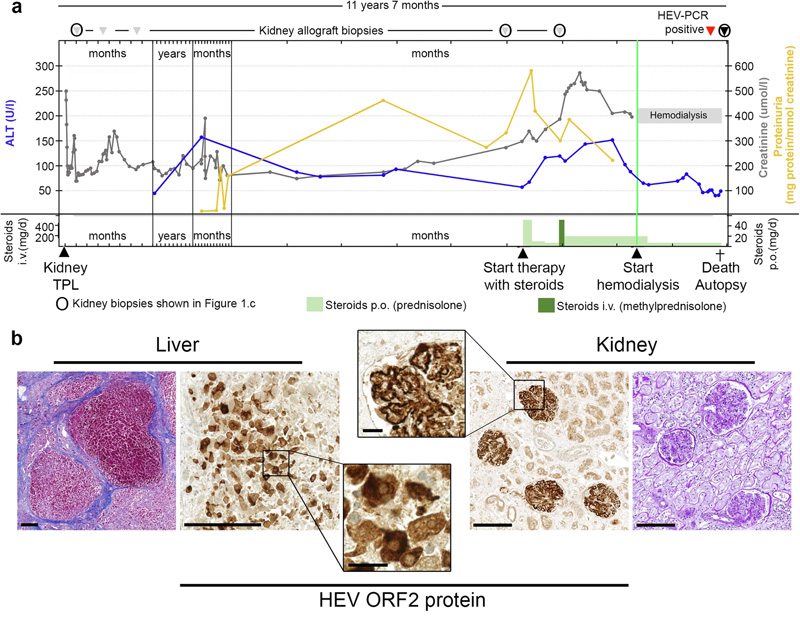 
戊型肝炎腎移植受者膜增殖型免疫復(fù)合物腎小球腎炎的臨床過程、尸檢結(jié)果和逐漸發(fā)展