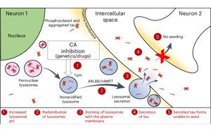 劍橋大學(xué)：青光眼藥物可能有助于預(yù)防阿爾茨海默病相關(guān)的tau蛋白積聚