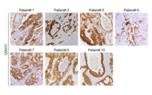 靶向鈣黏蛋白17(Cadherin-17/CDH17)的CAR-T細(xì)胞系統(tǒng)性遞送策略：安全有效治療結(jié)直腸癌肝轉(zhuǎn)移的新突破