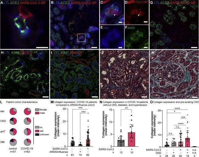 新冠病毒存在于感染者的腎細(xì)胞中并誘導(dǎo)腎臟纖維化 新冠病毒存在于感染者的腎細(xì)胞中并誘導(dǎo)腎臟纖維化