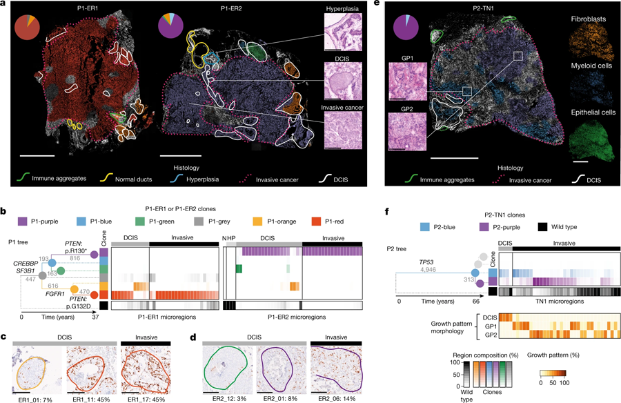 由三位原發(fā)性乳腺癌患者的組織學檢測繪制的遺傳克隆圖 由三位原發(fā)性乳腺癌患者的組織學檢測繪制的遺傳克隆圖