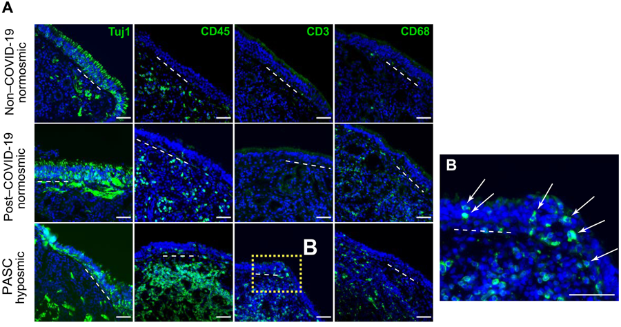 新冠肺炎急性后遺癥嗅覺粘膜下丘組織學評估提示T細胞浸潤的作用 新冠肺炎急性后遺癥嗅覺粘膜下丘組織學評估提示T細胞浸潤的作用