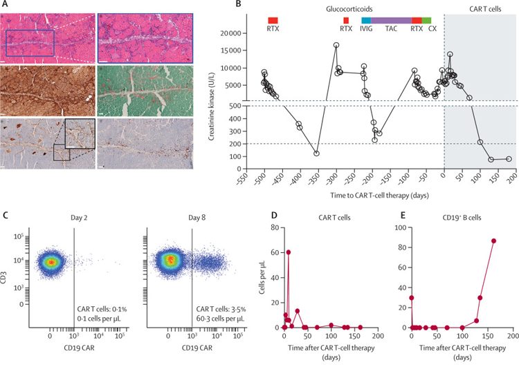 CAR T細胞對抗突觸綜合征表現(xiàn)的影響 CAR T細胞對抗突觸綜合征表現(xiàn)的影響