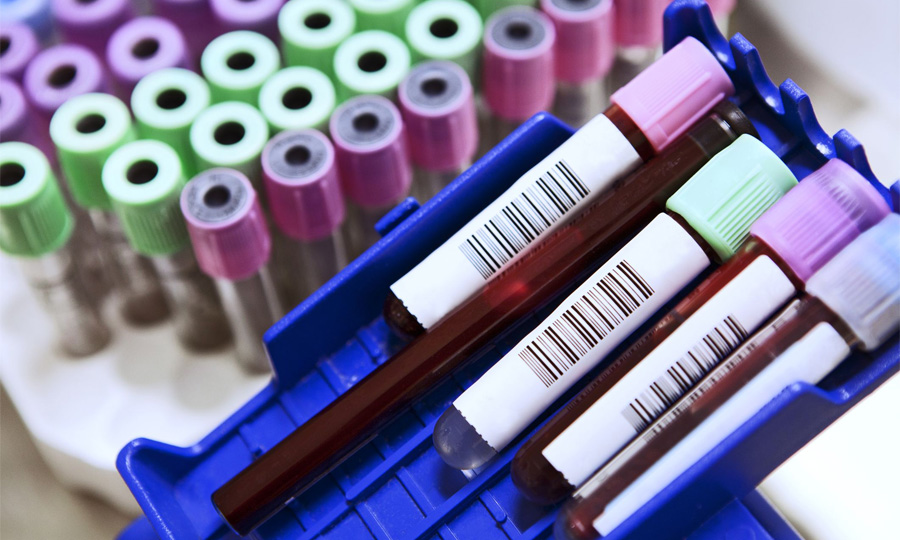 乳酸脫氫酶(LD/LDH)檢測 乳酸脫氫酶(LD/LDH)檢測