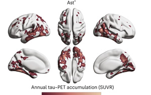 《Nature Medicine》阿爾茲海默癥新的血液生物標志物