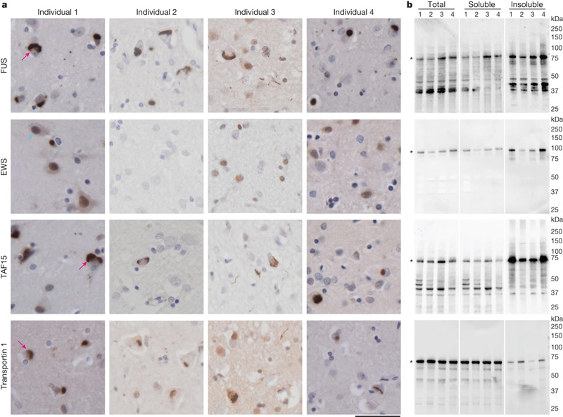 額顳葉退化蛋白包含F(xiàn)ET蛋白和遠(yuǎn)轉(zhuǎn)蛋白1 額顳葉退化蛋白包含F(xiàn)ET蛋白和遠(yuǎn)轉(zhuǎn)蛋白1